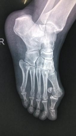 侧位看的不清楚