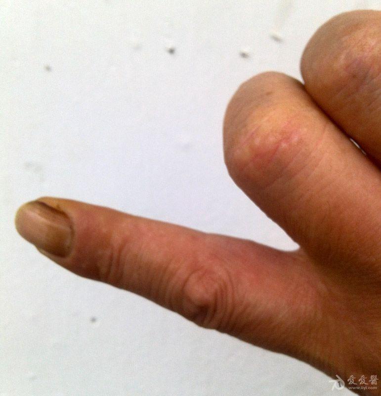 求助是汗疱疹还是手藓