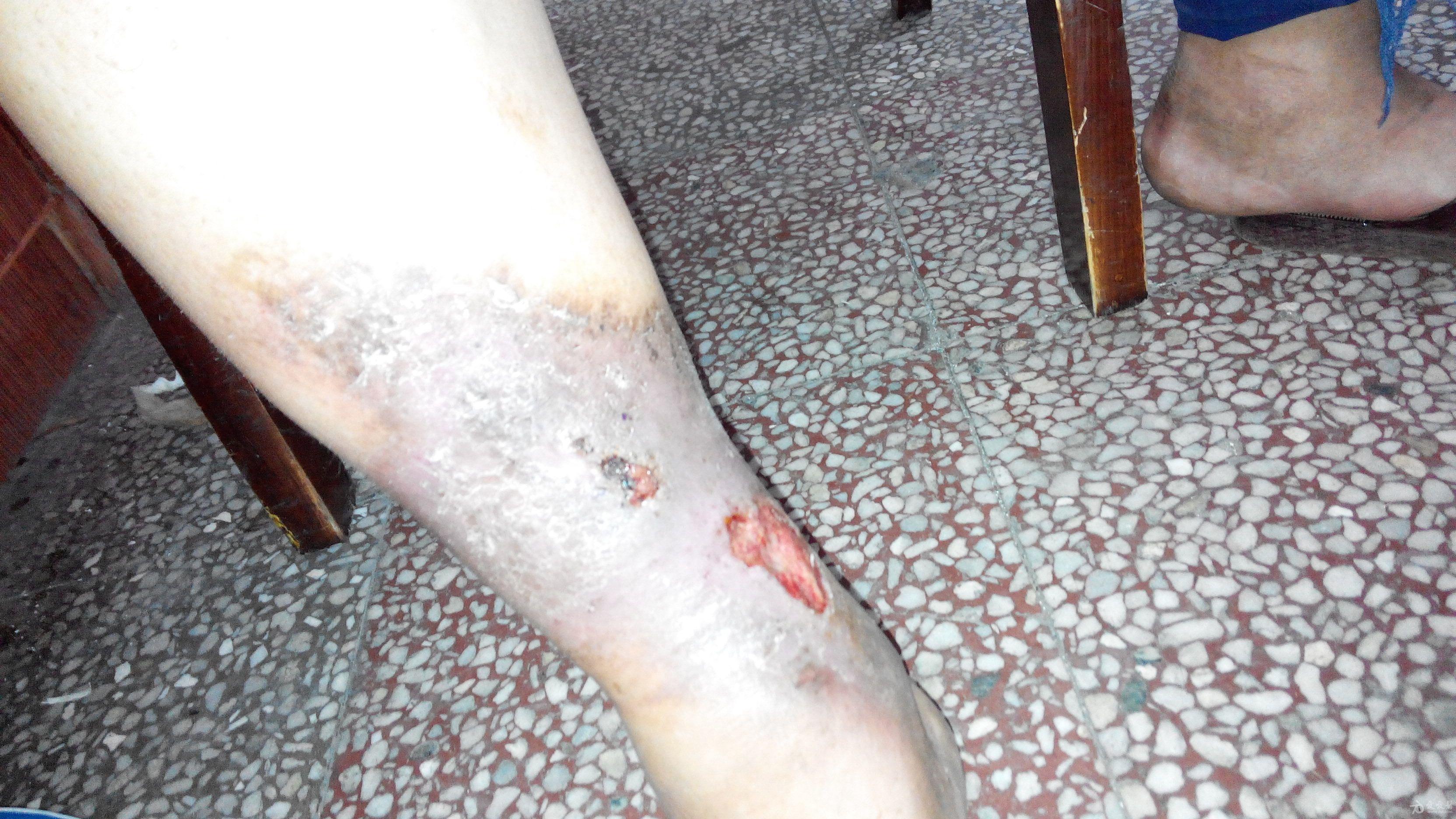 小腿溃疡如何处理?