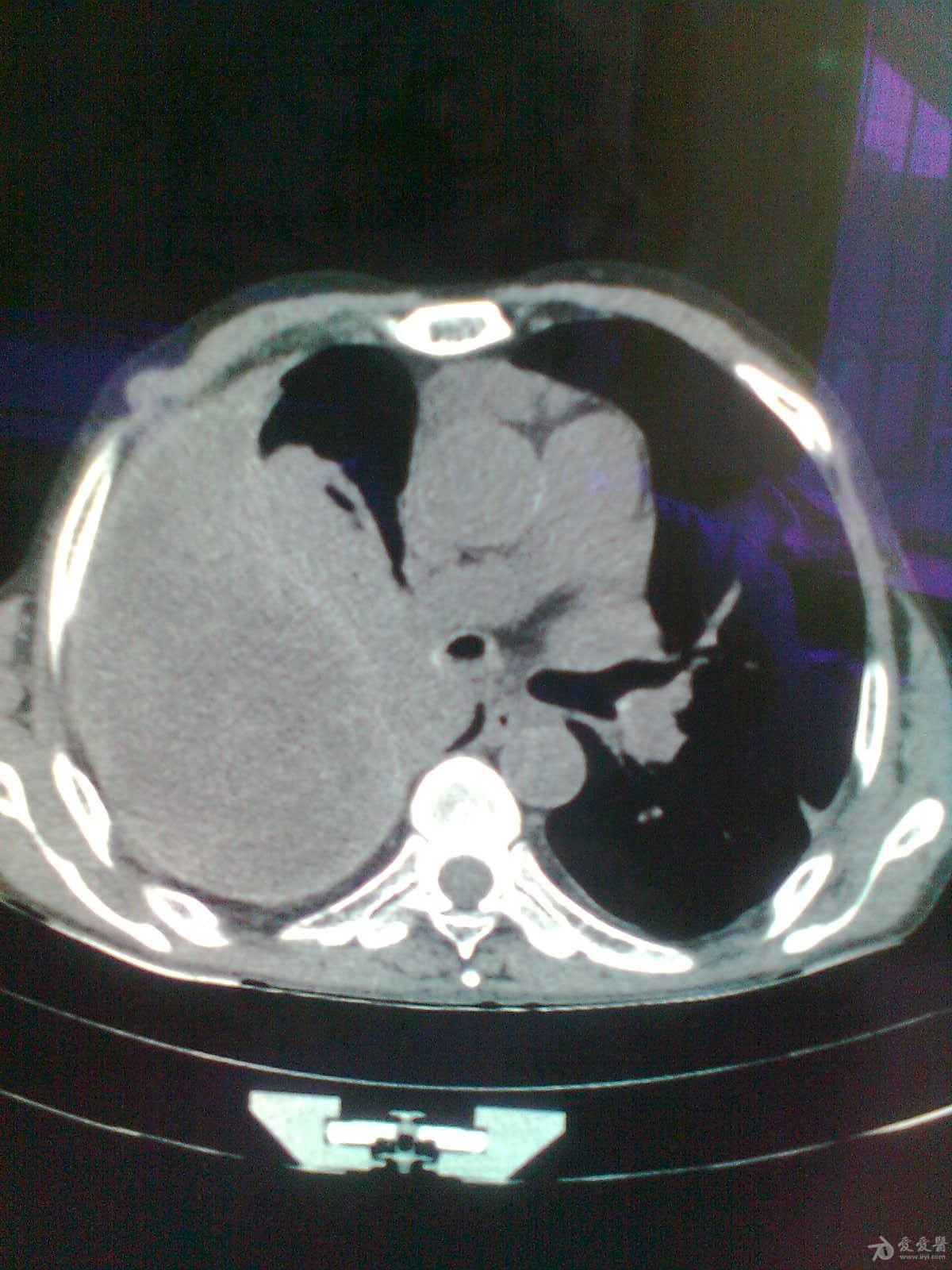 心包隐窝积液CT图片