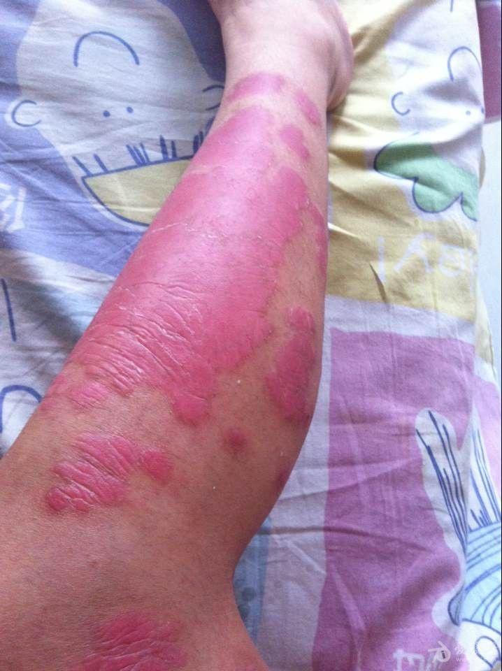 一名银屑病患者 请大家给鉴定一下这位患者是否是 红皮型银屑病