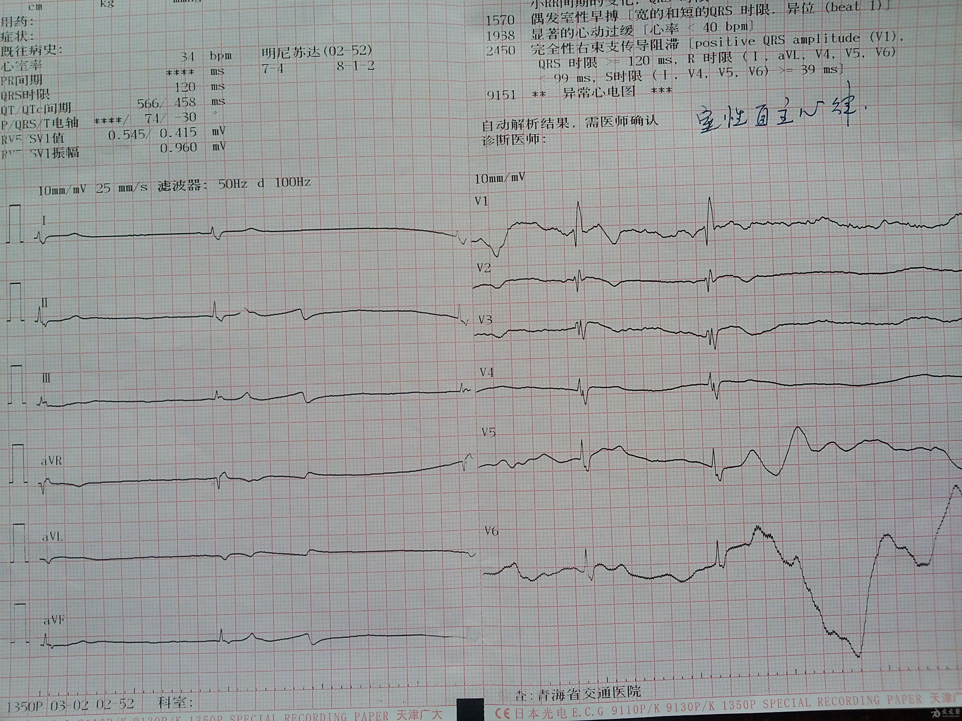 临终心电图诊断结论图片