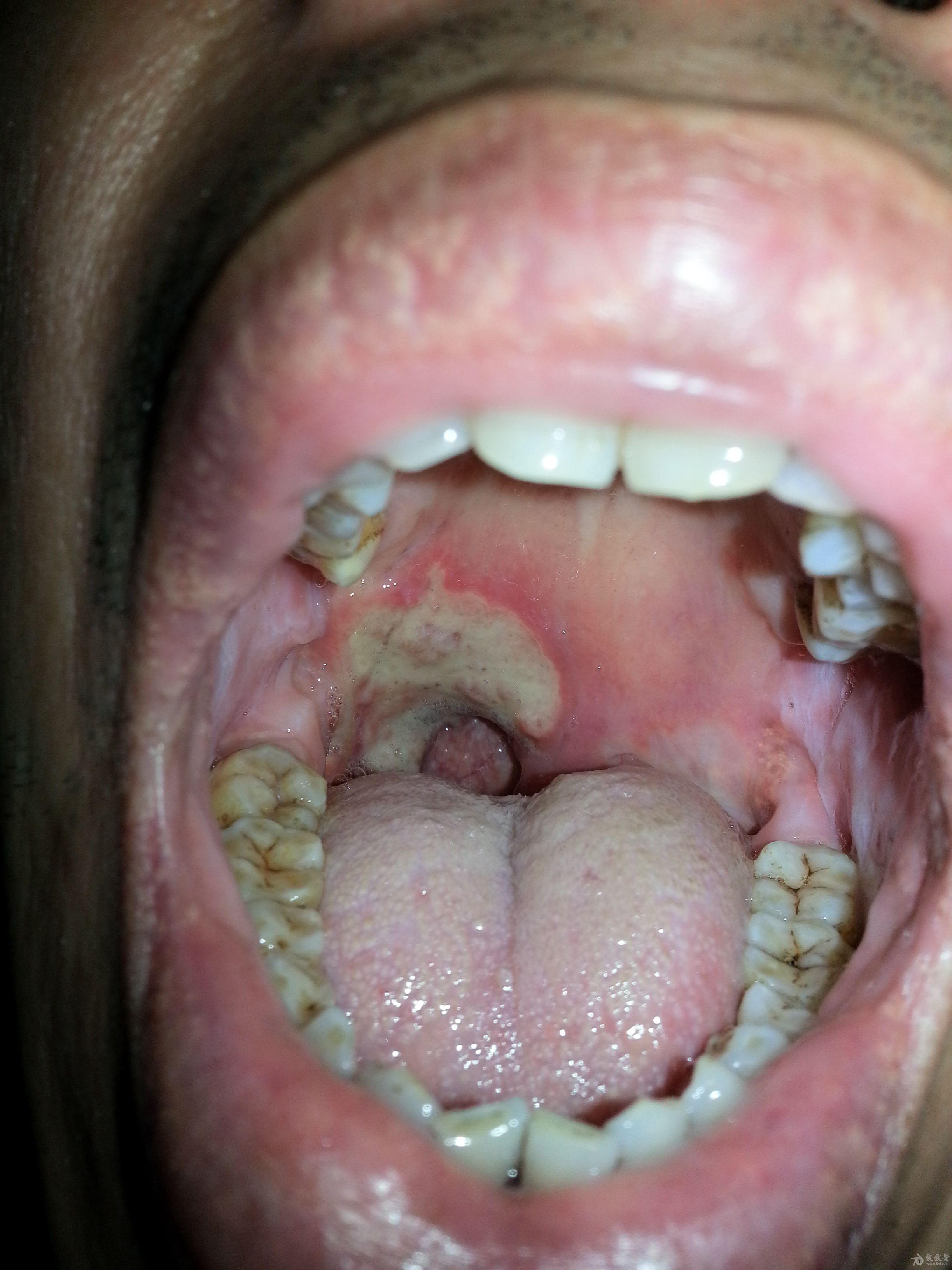 口腔溃疡晚期图片图片