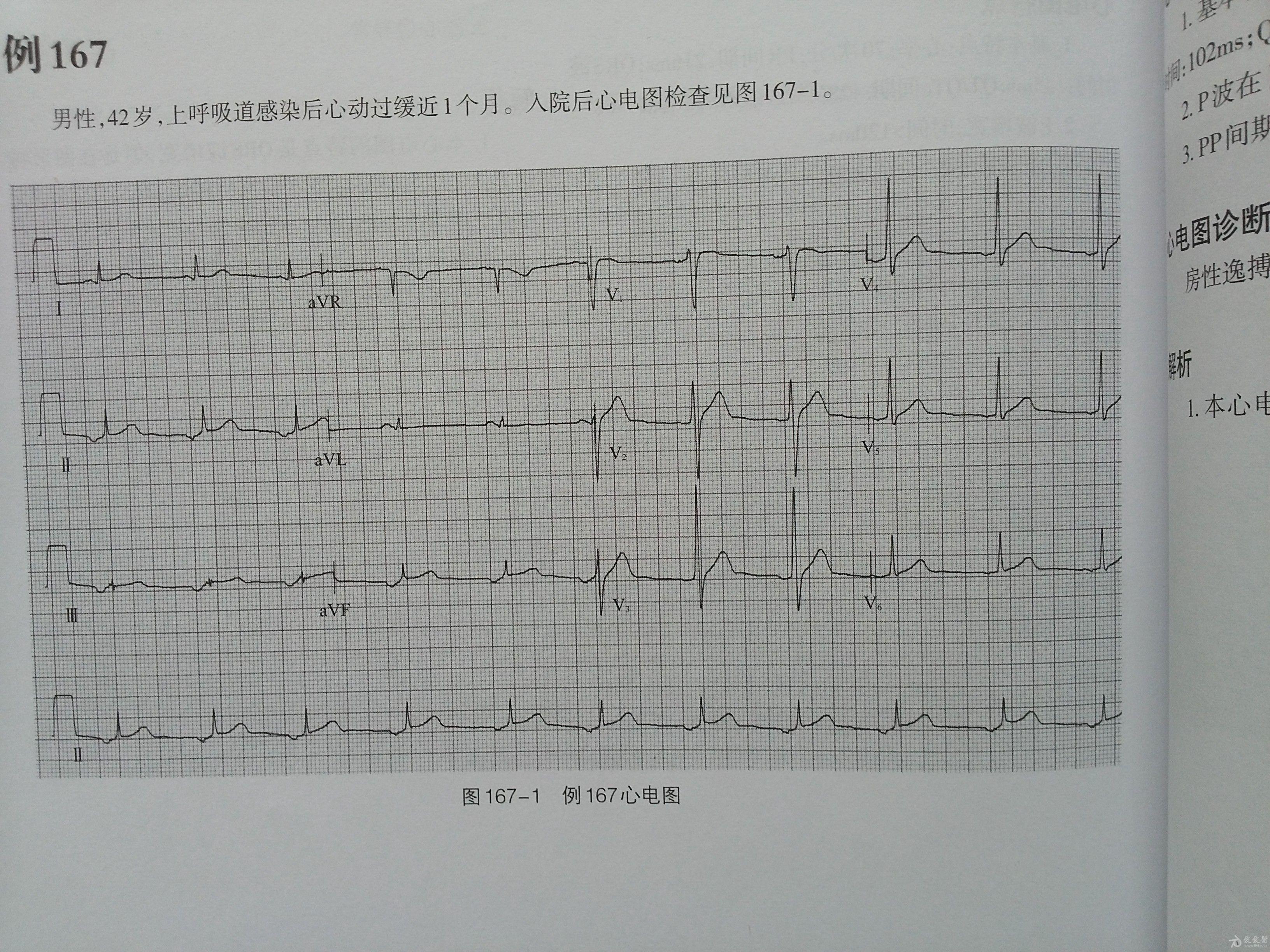 房性逸搏心律 - 心电图脑电图专业讨论版 - 爱爱医医学论坛