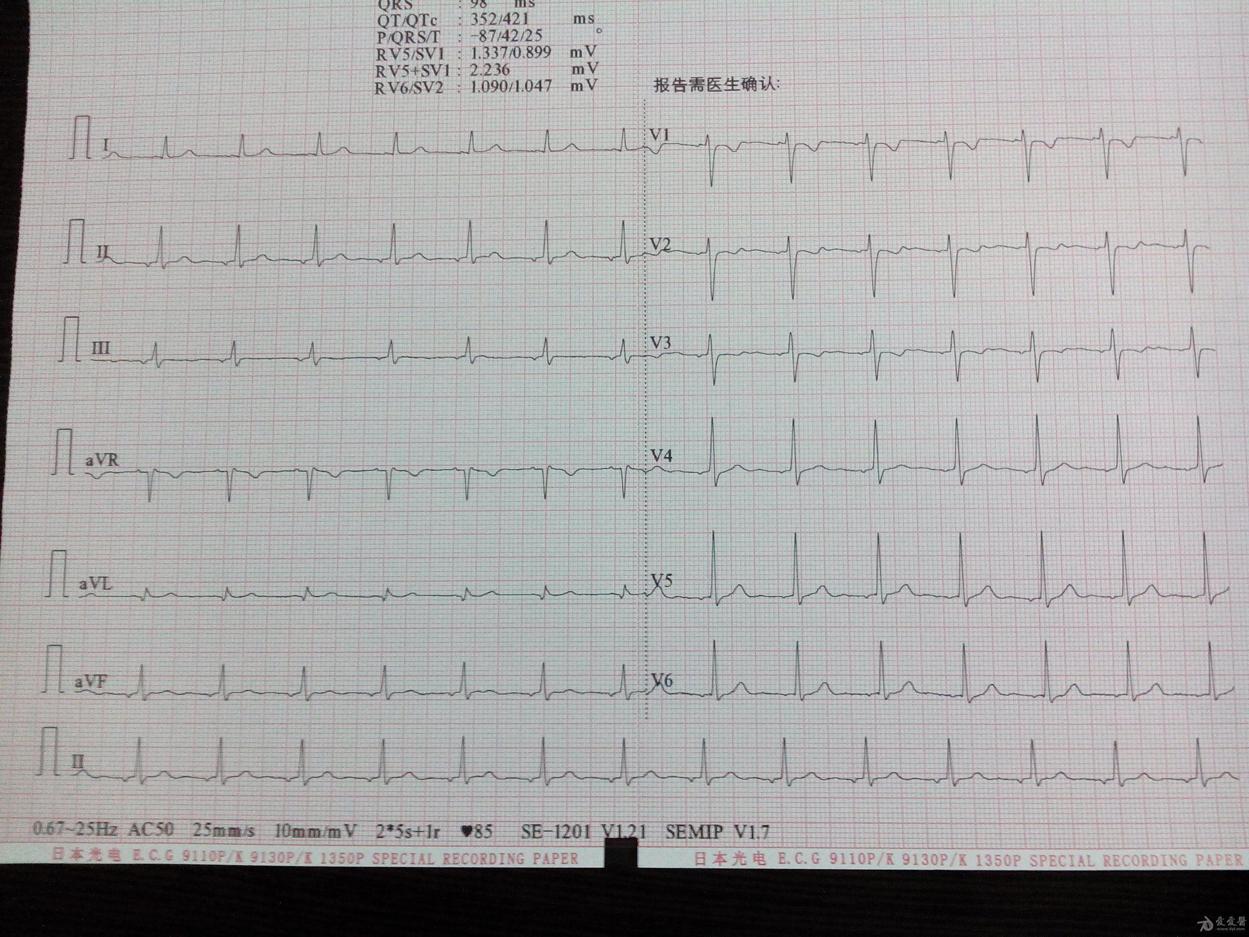 這是左房節律嗎? - 心電圖腦電圖專業討論版 - 愛愛醫醫學論壇