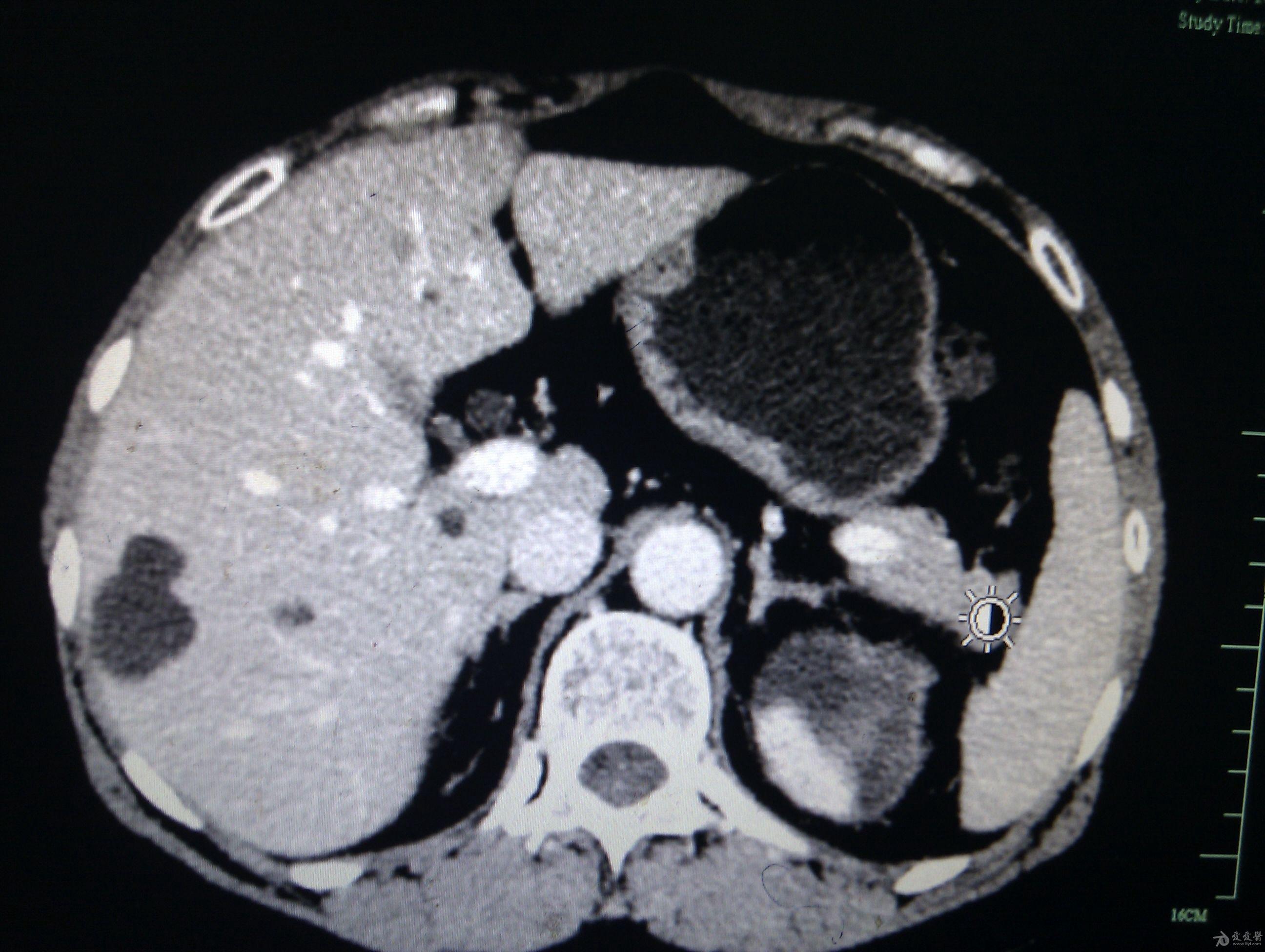 自发性双肾包膜下血肿求原因