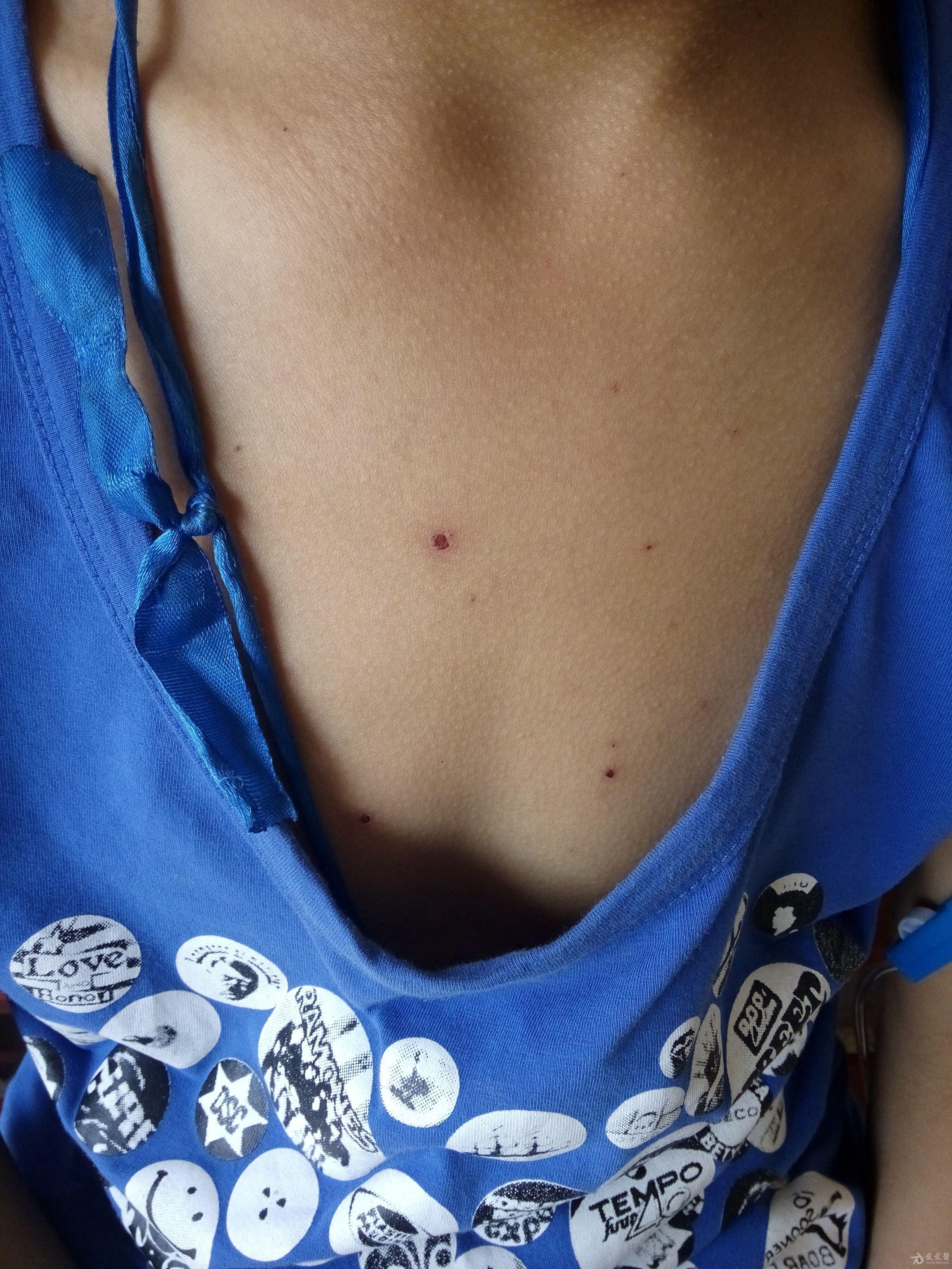 看图诊断水痘并治学习交流