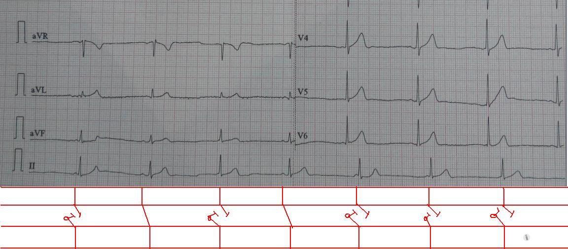 交界性自主心律心电图图片