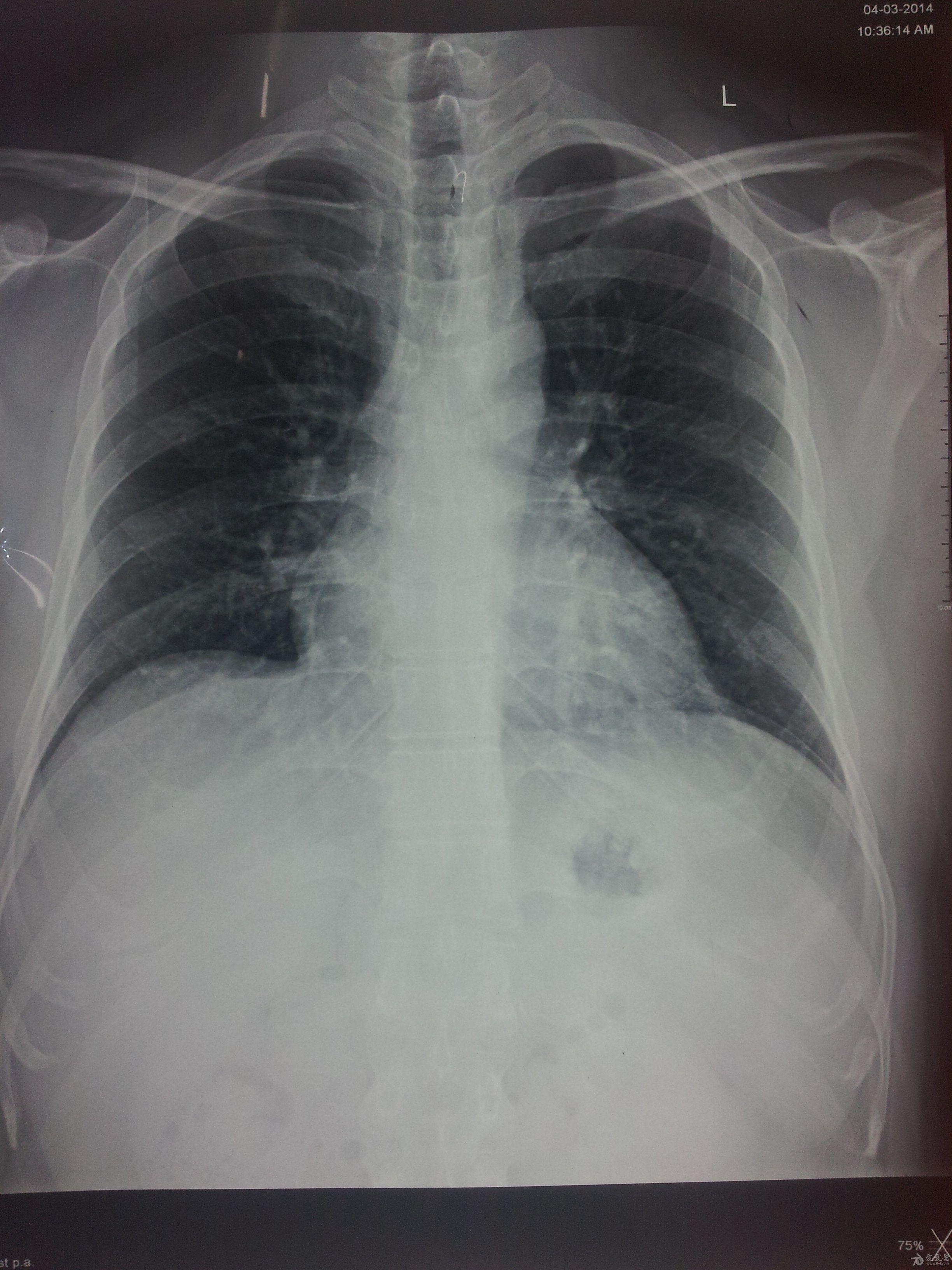肺部发炎ct图片图片