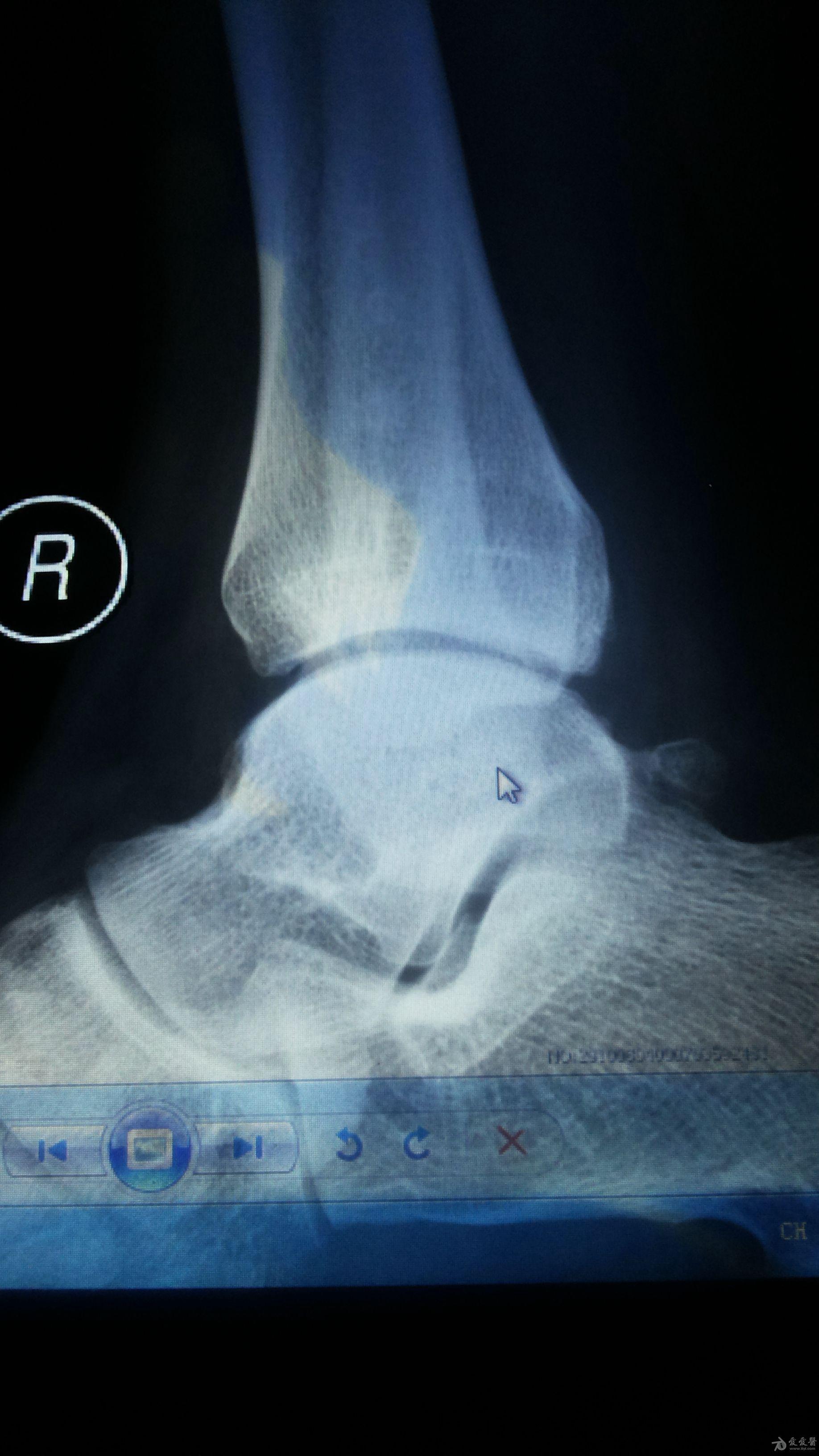 右外踝骨折内固定取出两年半后患者踝骨节疼痛(有片)