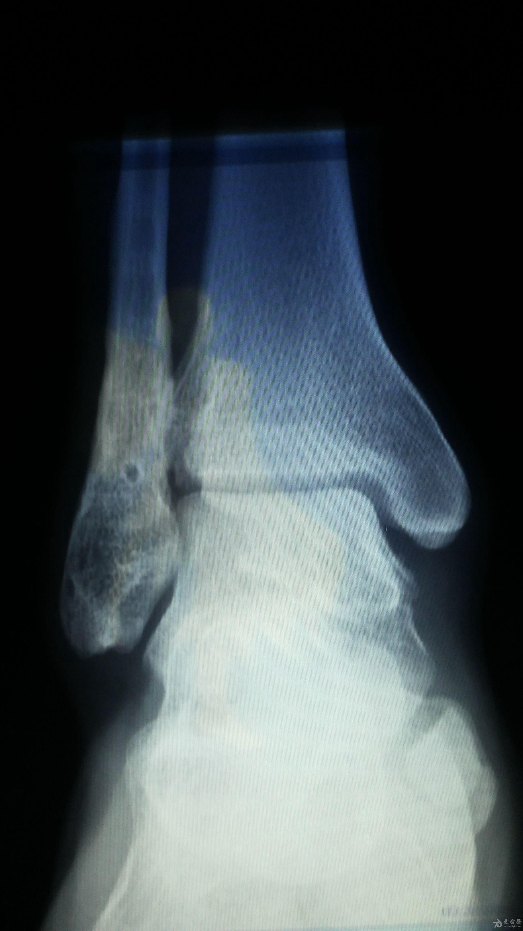右外踝骨折内固定取出两年半后患者踝骨节疼痛有片