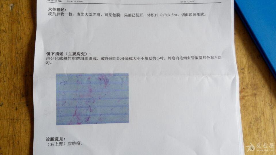 怀疑上臂肌间脂肪瘤一例