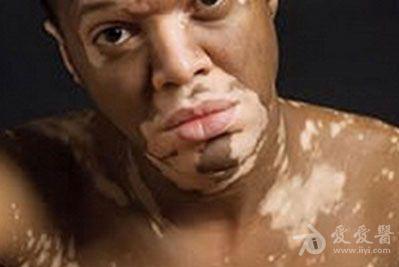 不分钟族的皮肤病--白癜风 - 皮肤及性传播疾病讨论版 - 爱爱医医学