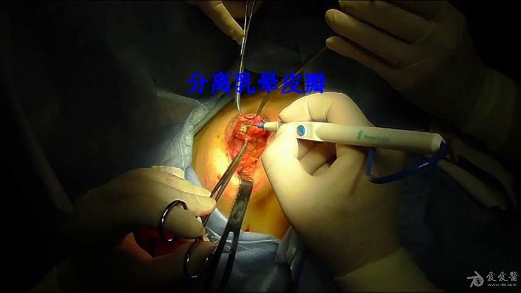 浆细胞性乳腺炎 手术图片