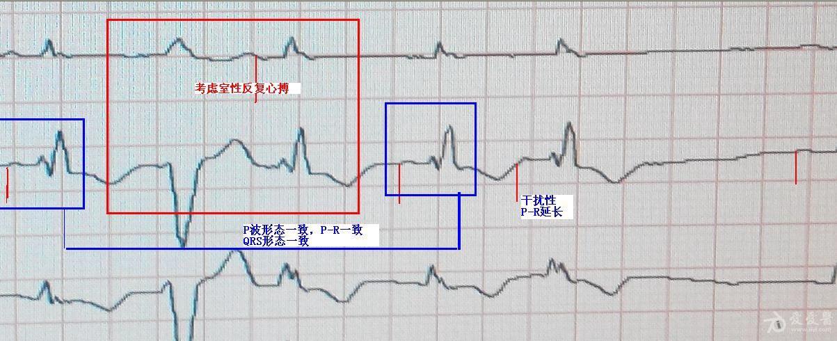 心電圖腦電圖專業討論版 - 愛愛醫醫學論壇