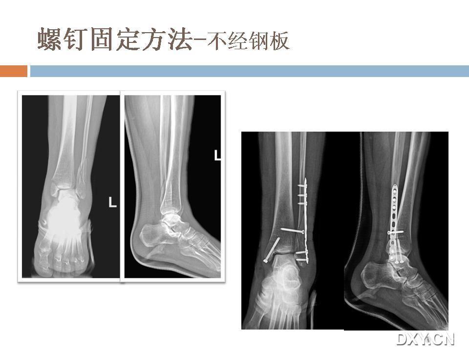 下胫腓关节分离图片