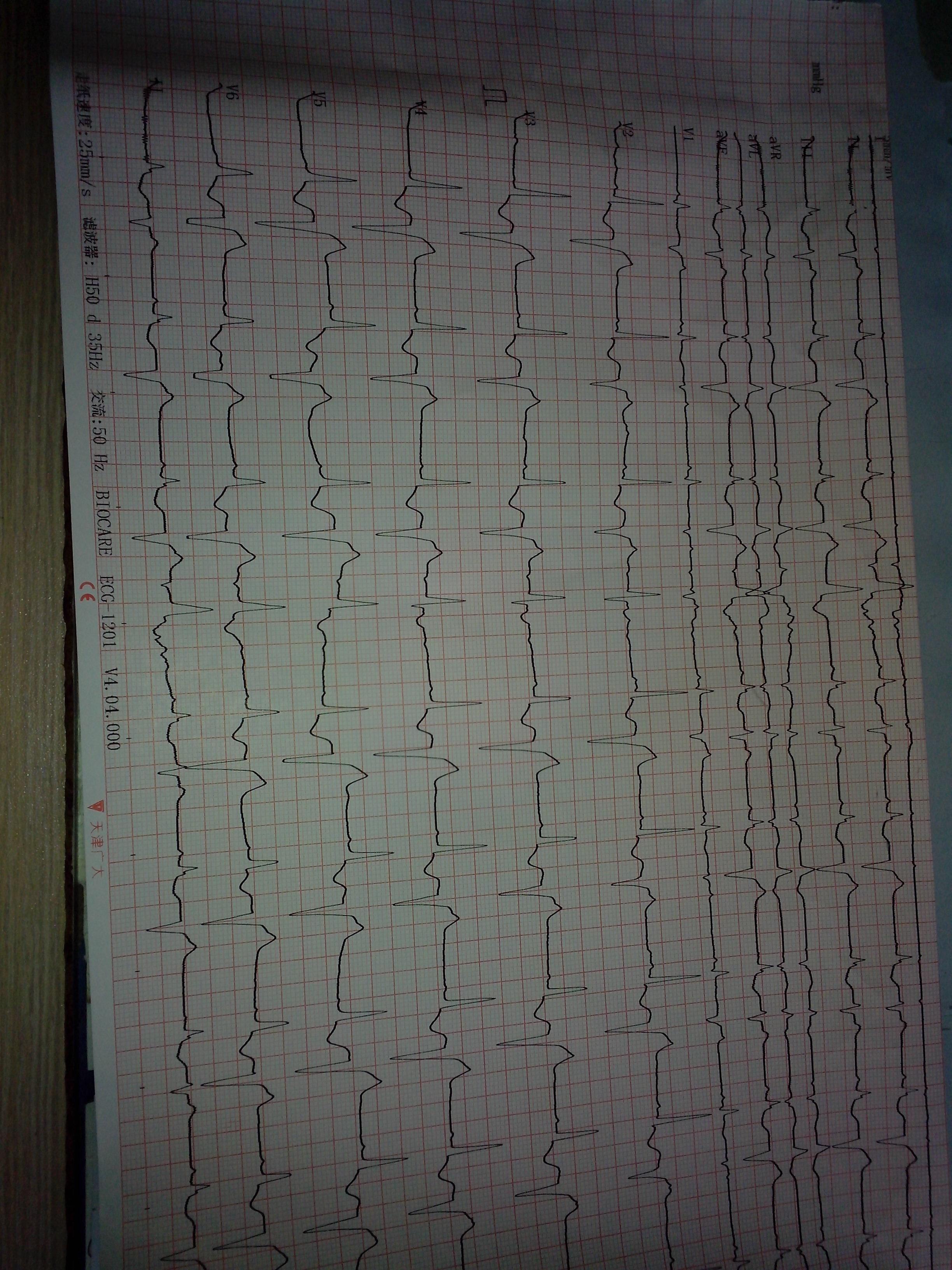 多源性室早心电图图片图片