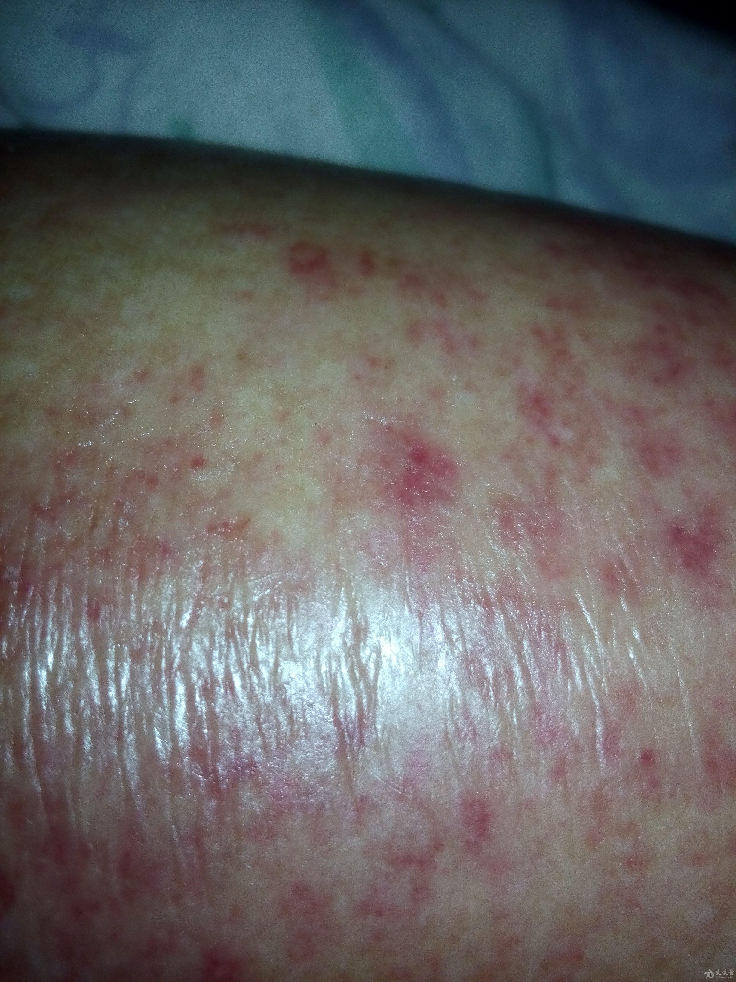 病例讨论这是皮肤病还是血管问题