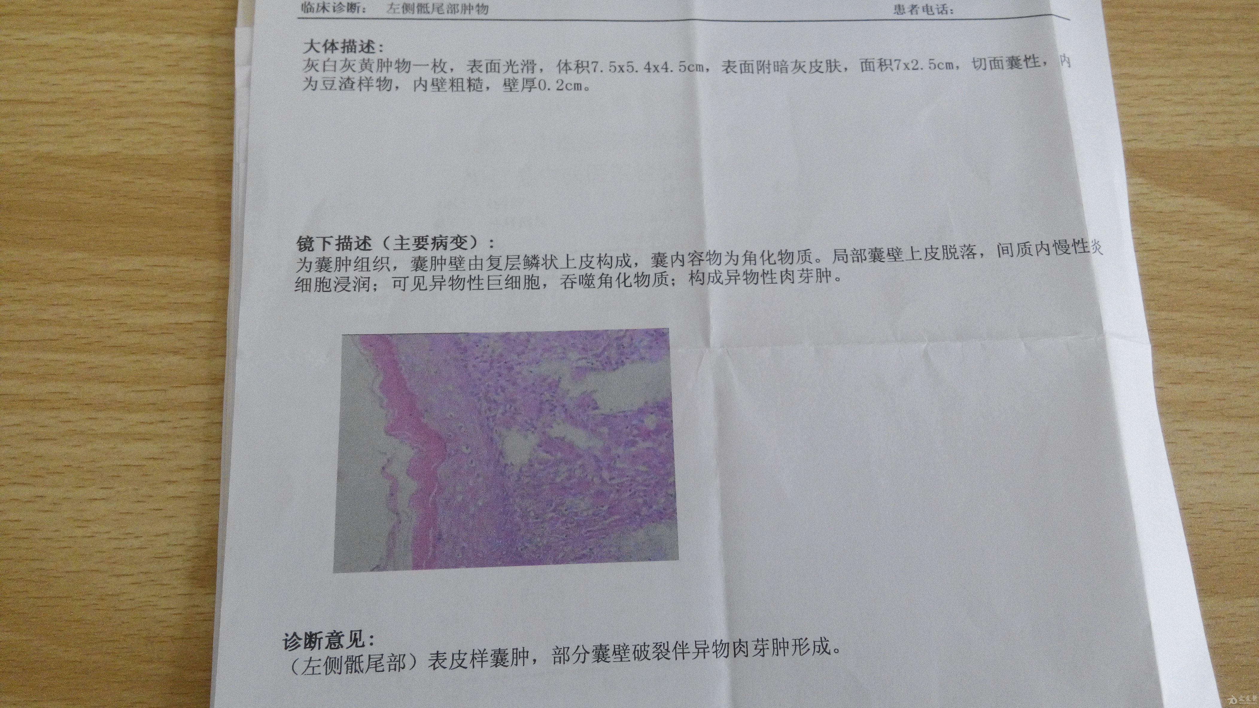 人尾巴骨上长囊肿图片图片