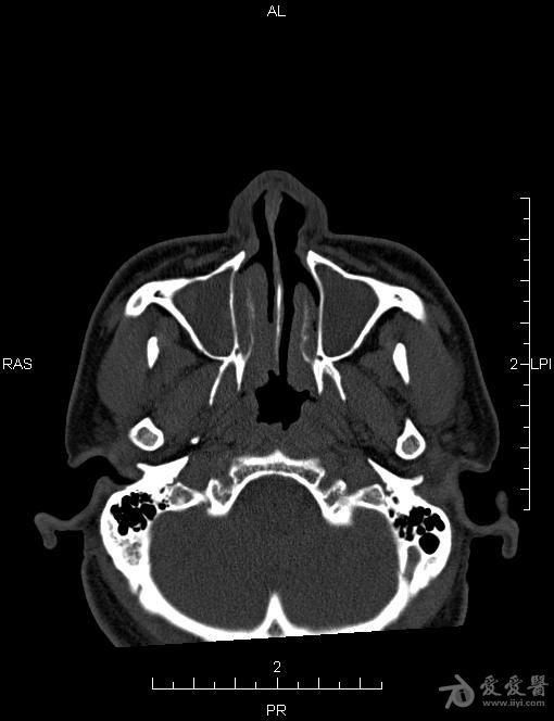 慢性鼻窦炎CT图片