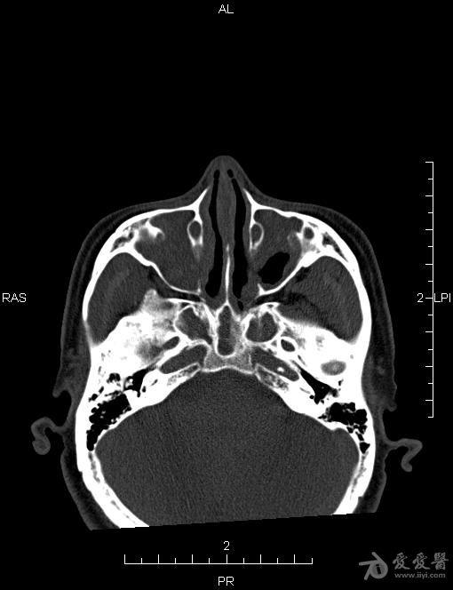 窦口鼻道复合体CT图图片