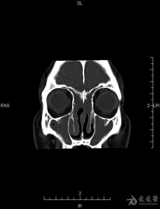 副鼻窦ct平扫图片图片