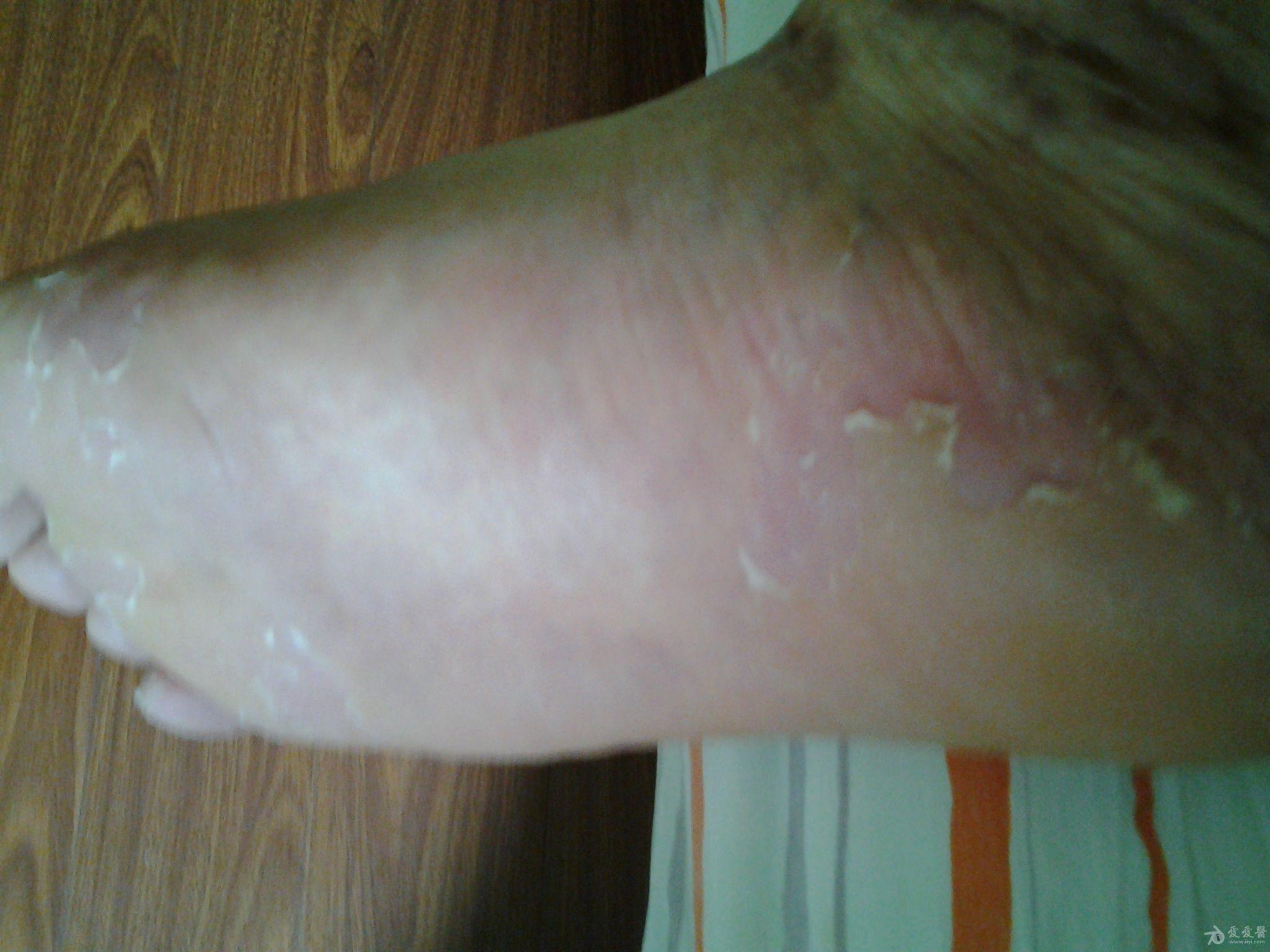 怎样才能治好脚癣 140701231655akxxdjxkpda3kmvt.jpg