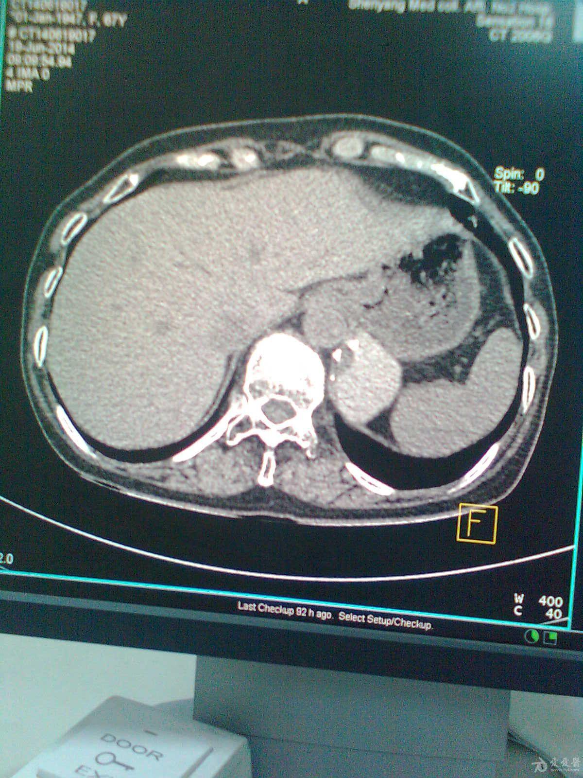 左侧肾上腺高密度占位