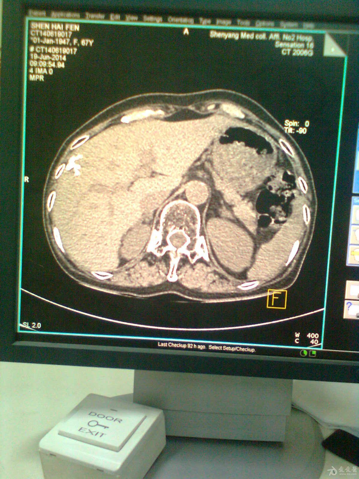 左侧肾上腺高密度占位