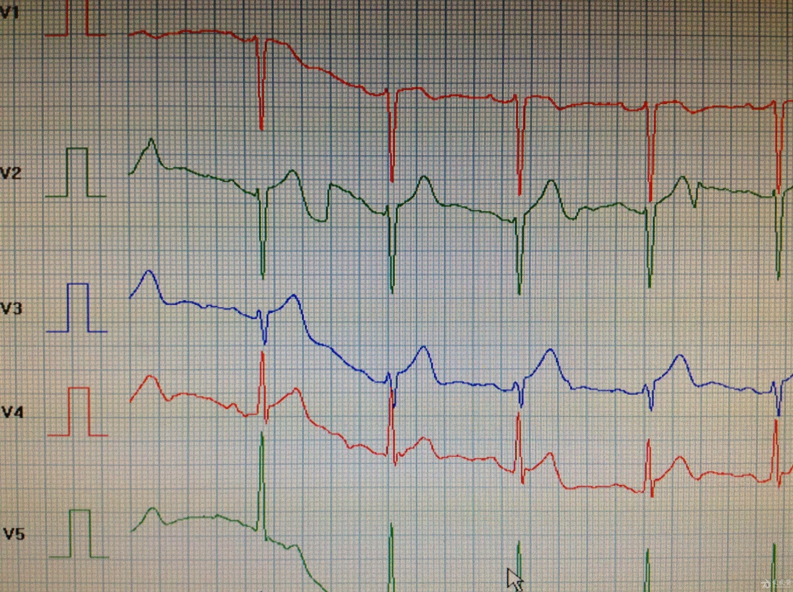 心电图r波两个尖图片