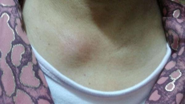 右侧锁骨较左侧突起