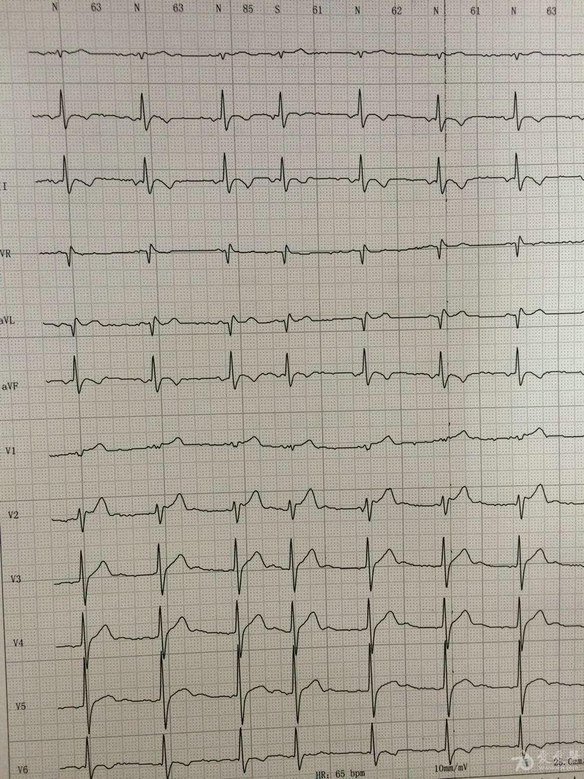 较乱的一份动态心电图