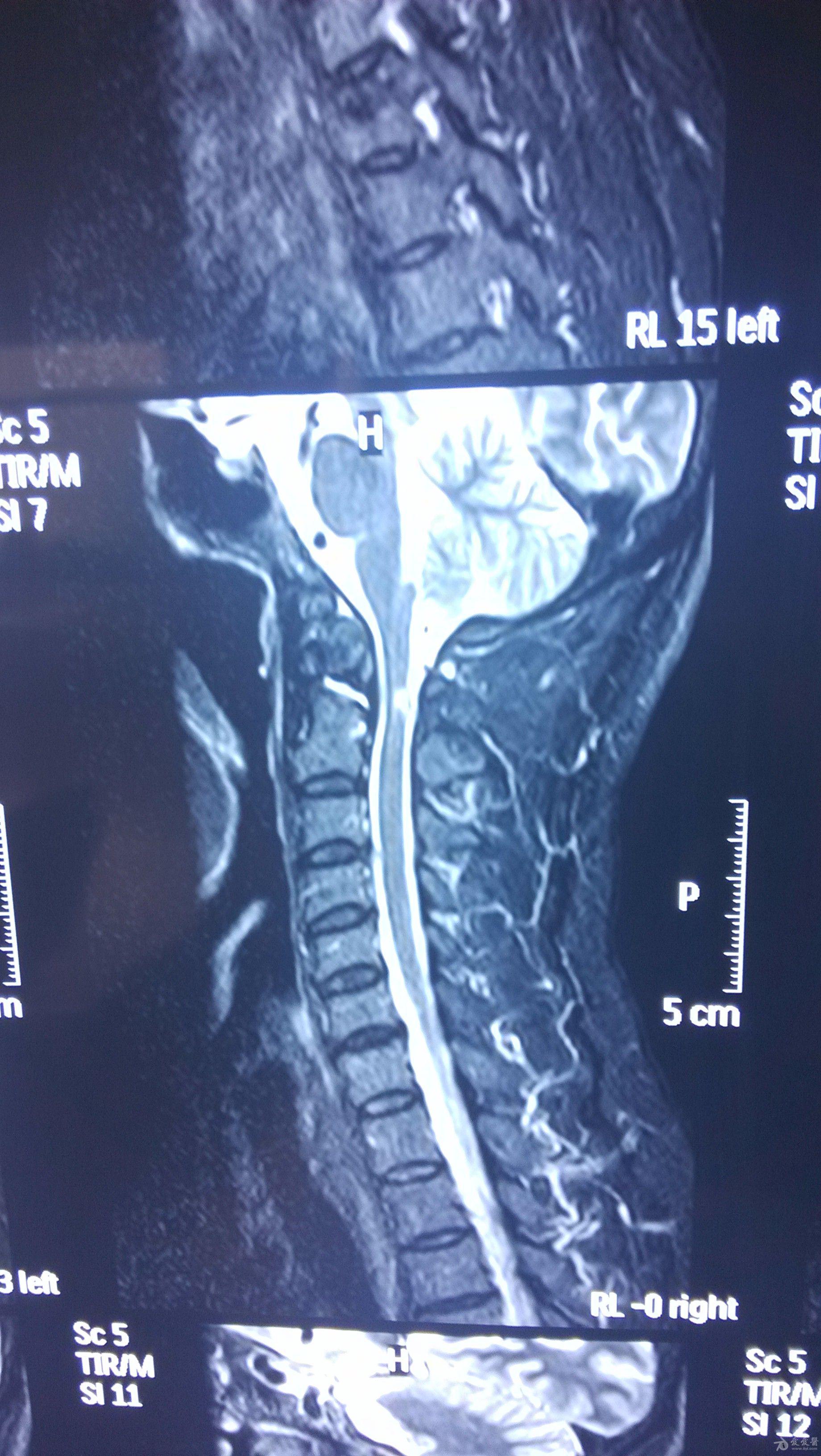 颈椎错位片子图片图片