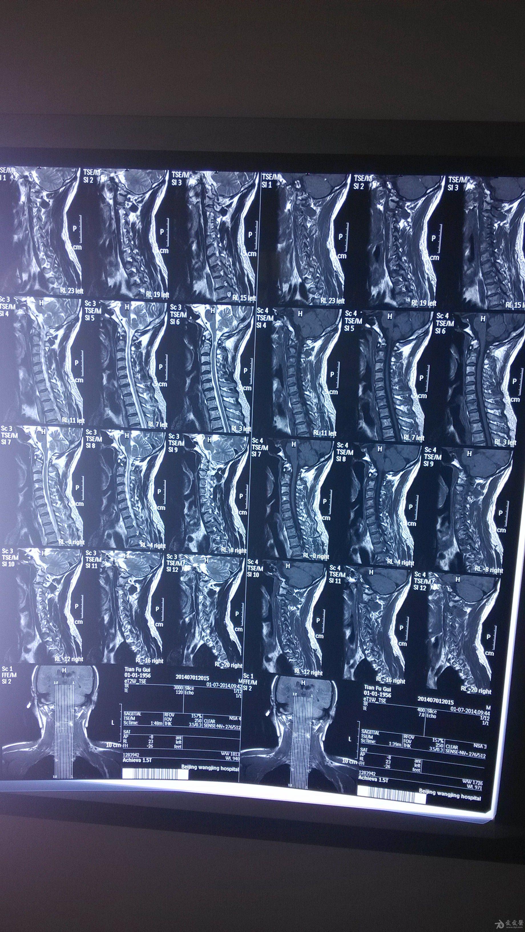 颈椎病片子图片