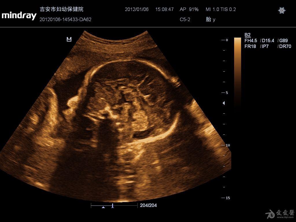 胎儿胼胝体缺如图片