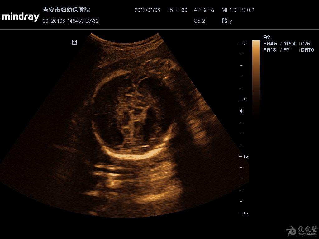 胎儿胼胝体缺如图片