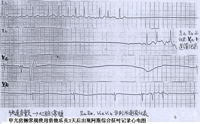 阿斯综合征心电图图片