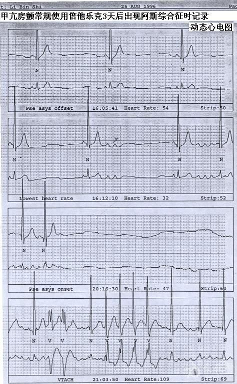 阿斯综合征心电图图片