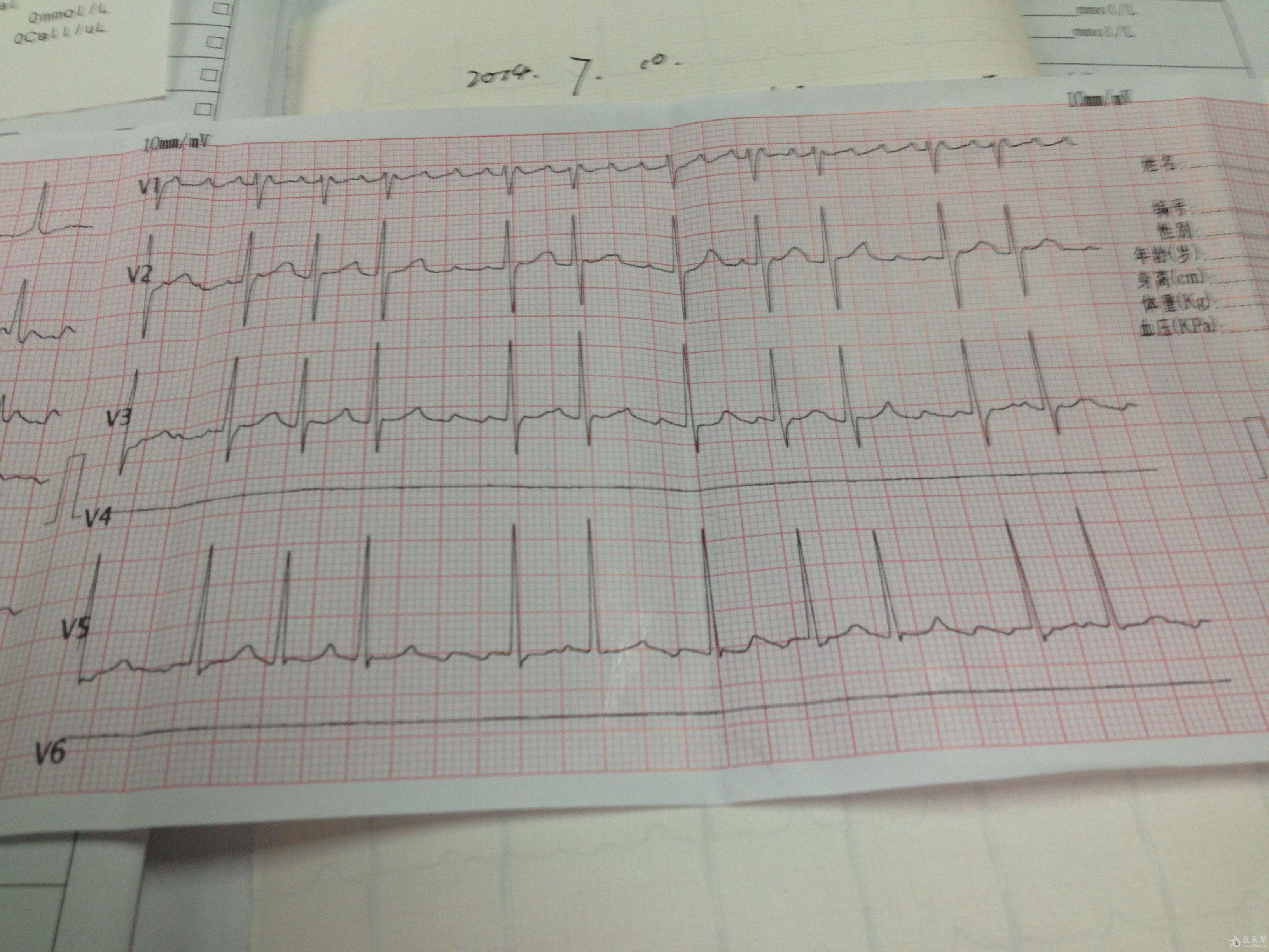 心电图红印照片图片