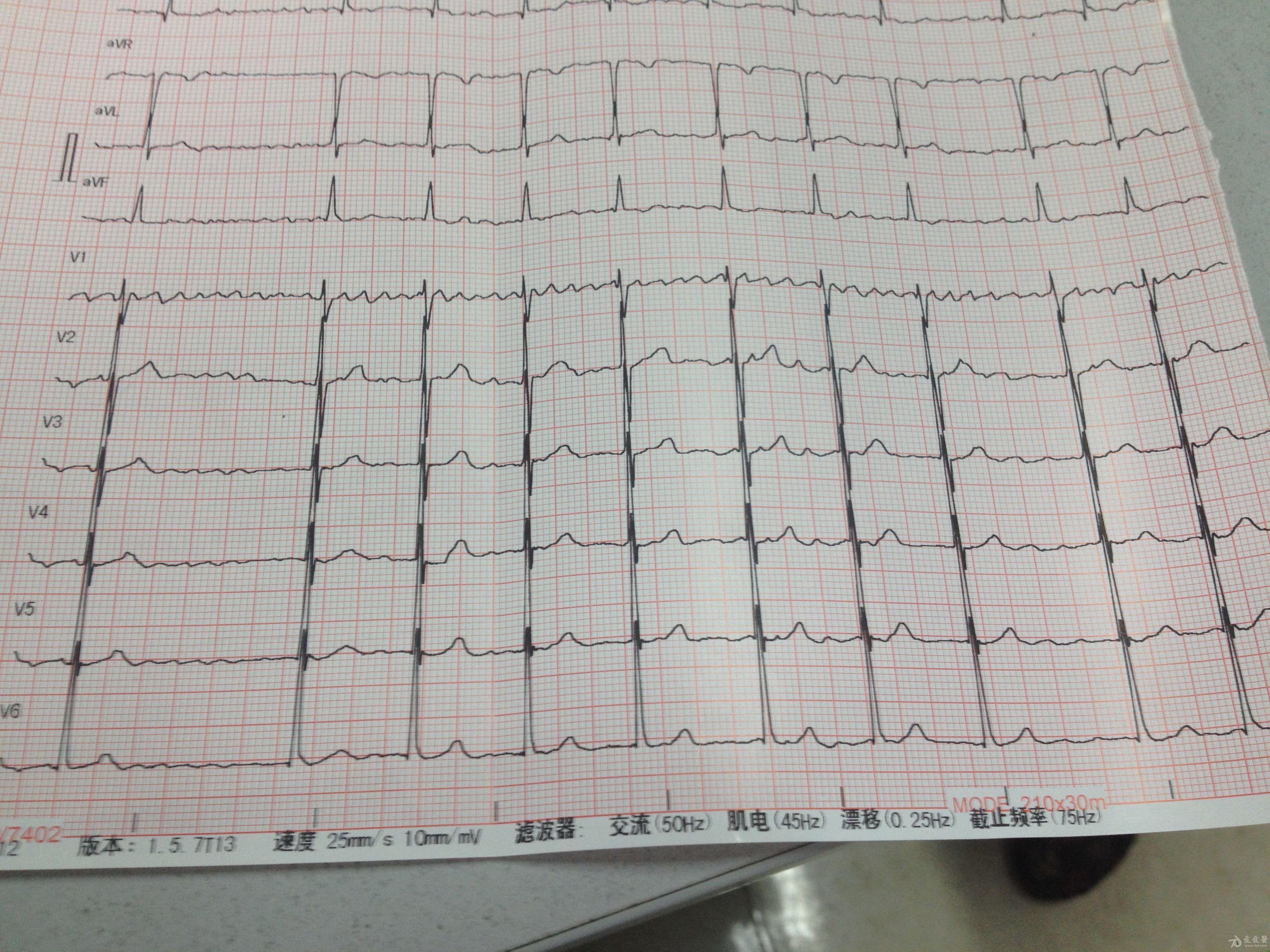 心电图红印照片图片