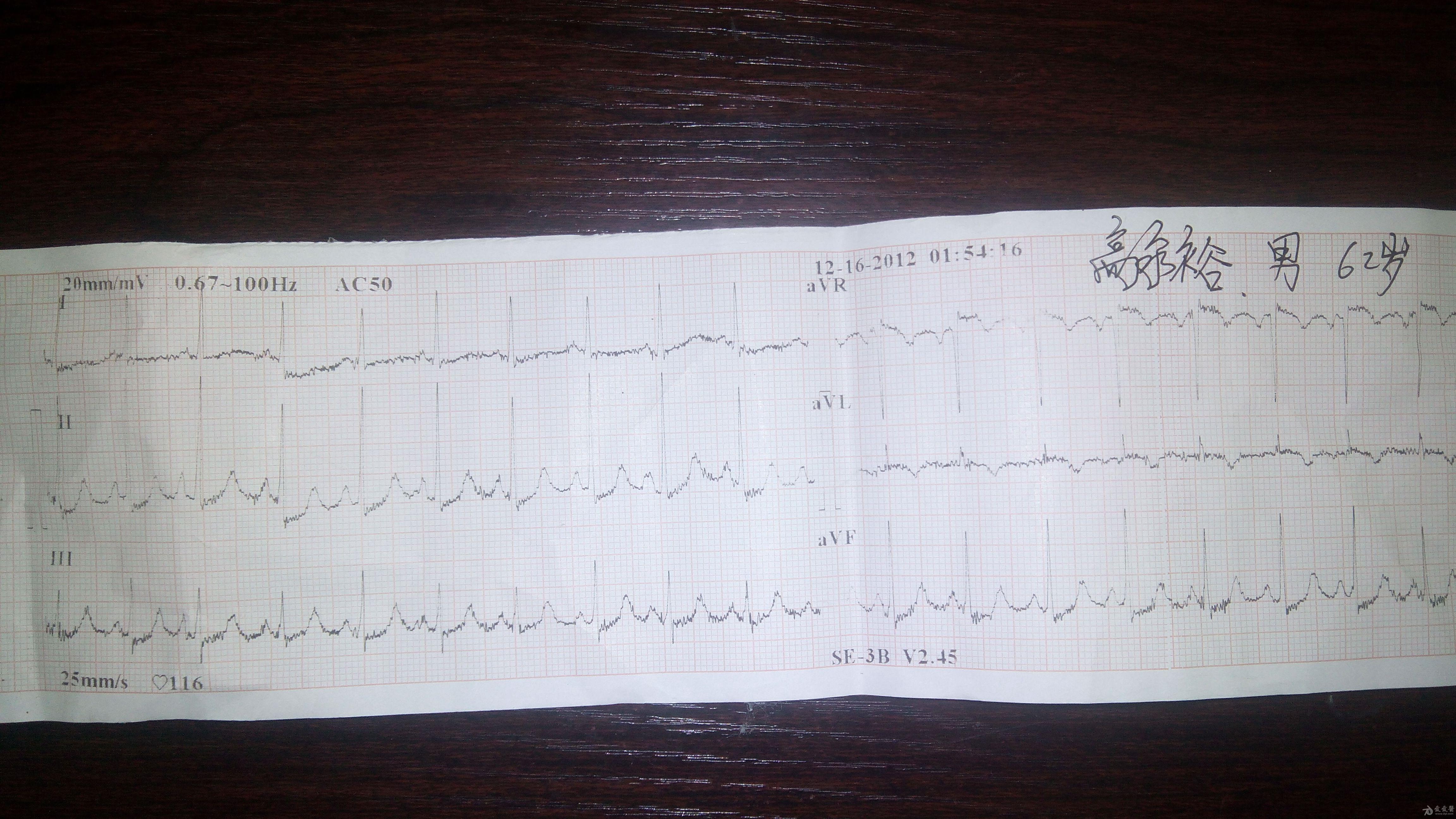 心电图t波高尖大家看看该是什么诊断