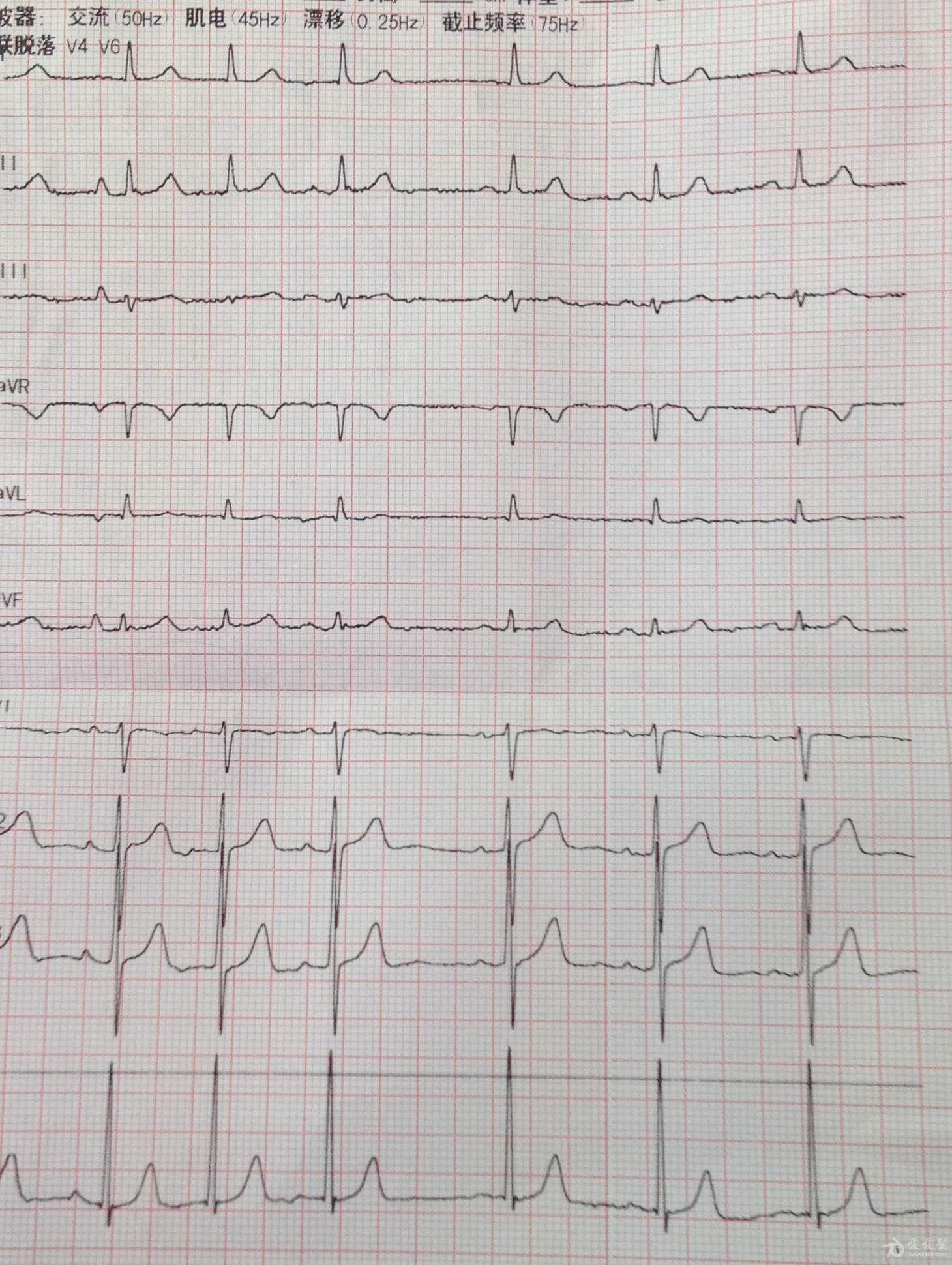 心电图 求解?