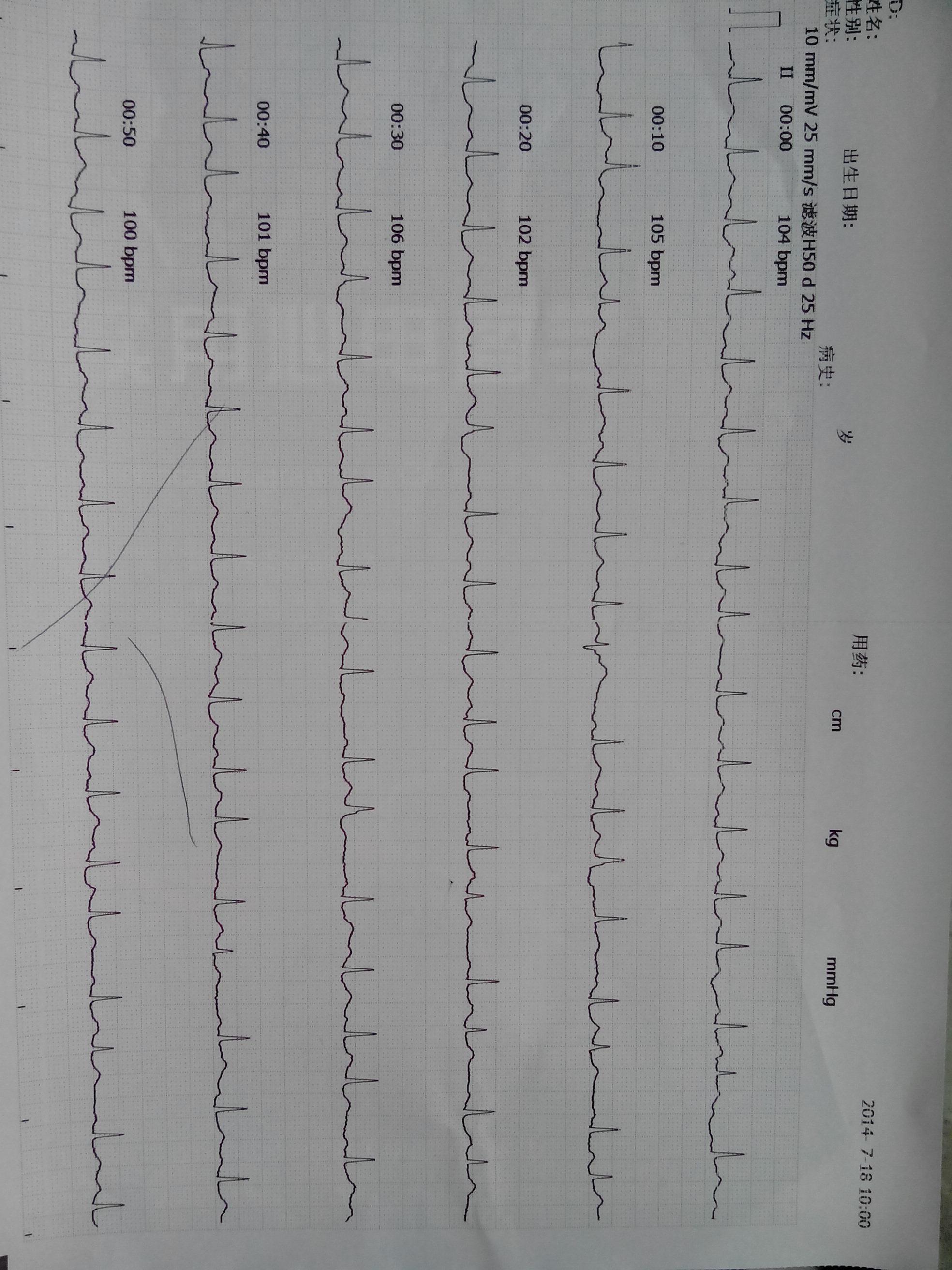 看下是什麼心律失常 - 心電圖腦電圖專業討論版 - 愛愛醫醫學論壇