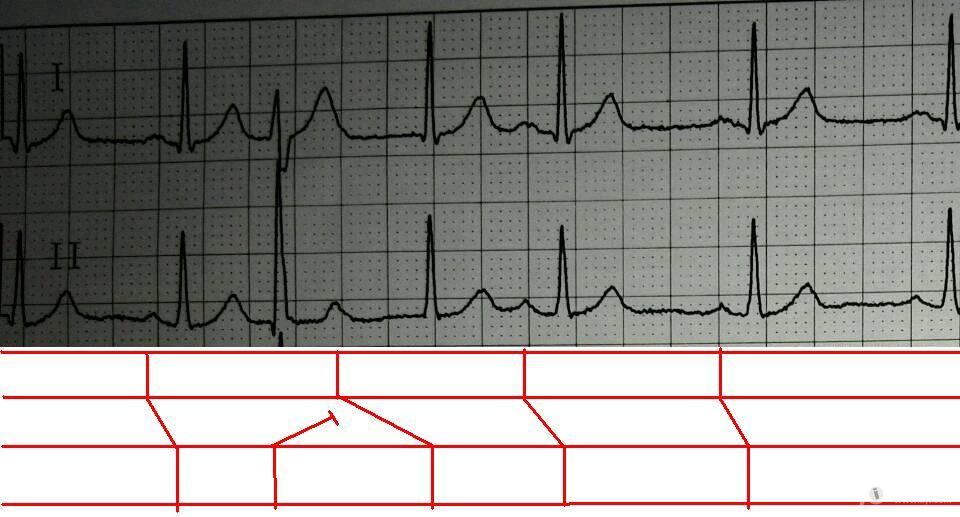 請教這個圖要如何分析 - 心電圖腦電圖專業討論版 - 愛愛醫醫學論壇