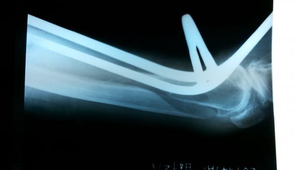 牵引后床旁侧位片