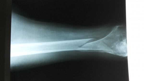 牵引后床旁正位片