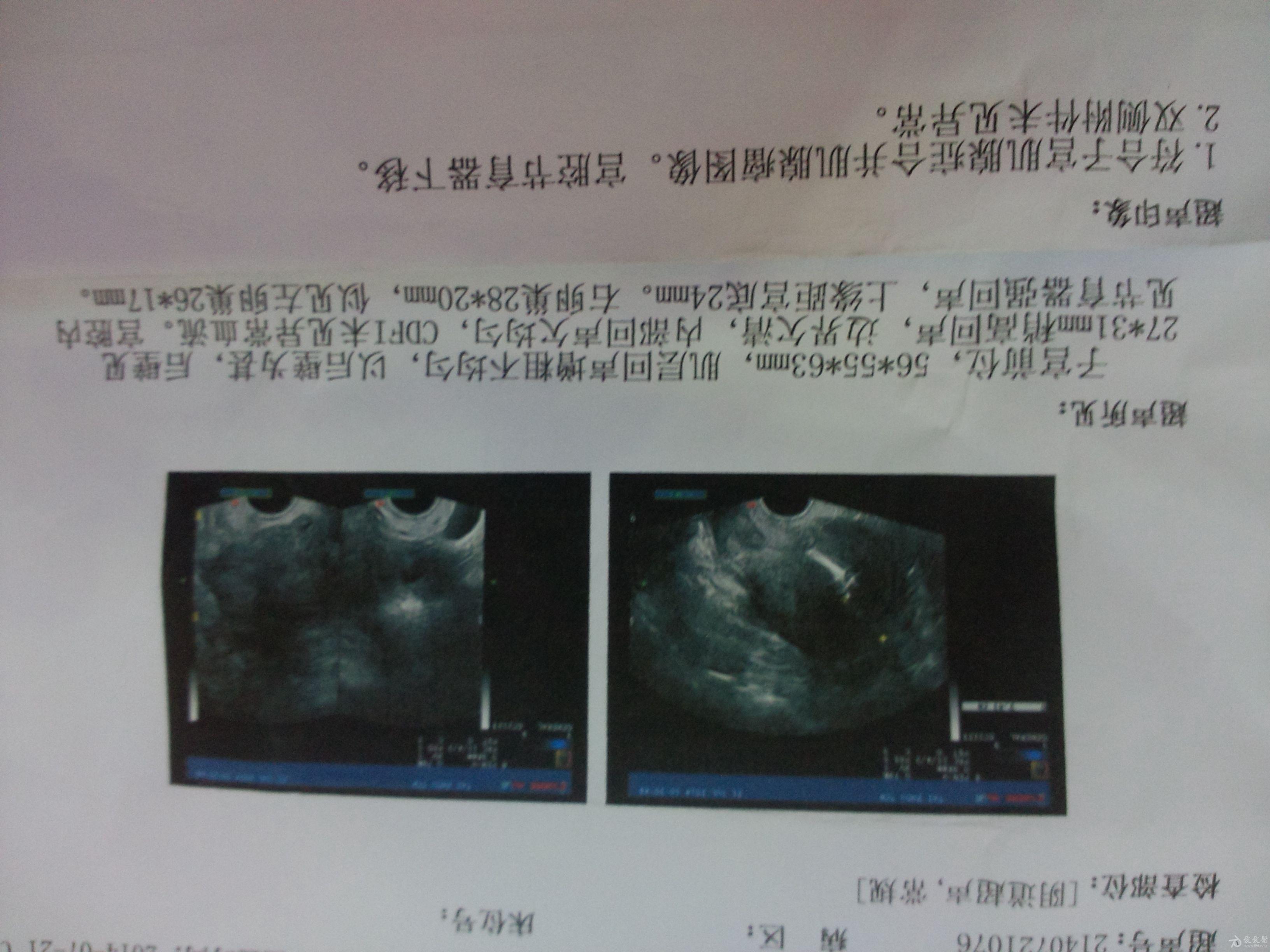 求教:痛經,陰超報告診斷分析