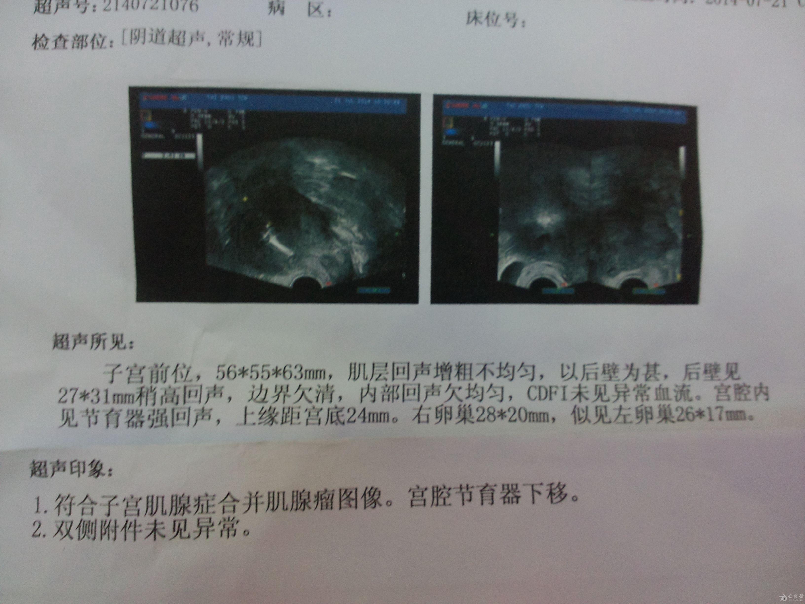 经阴超检查图片