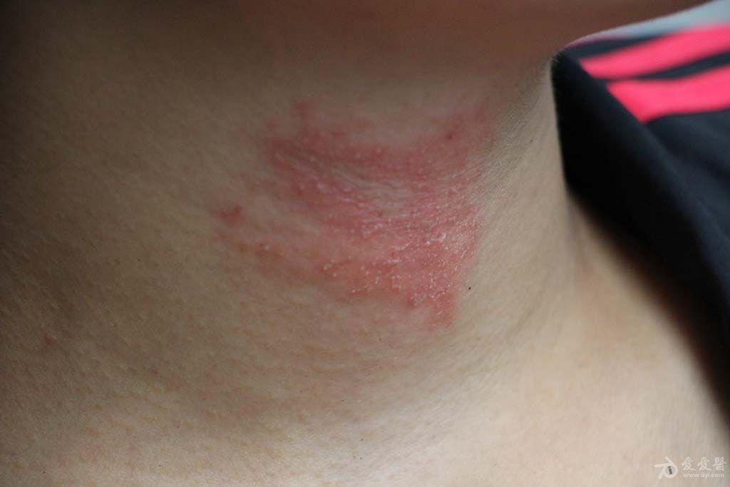 猜图病例20147答案隐翅虫皮炎