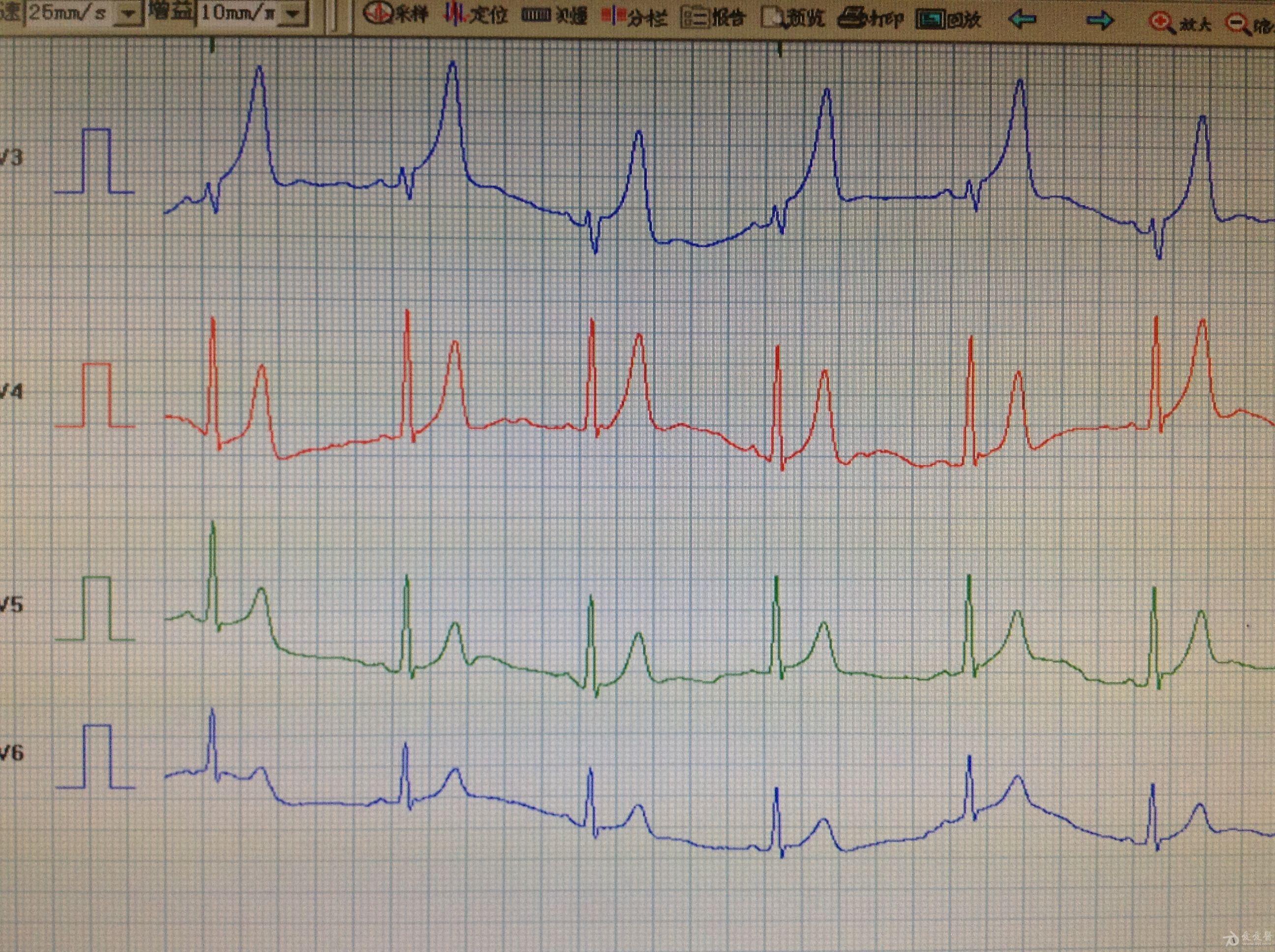 帮忙分析下这个心电图的v1
